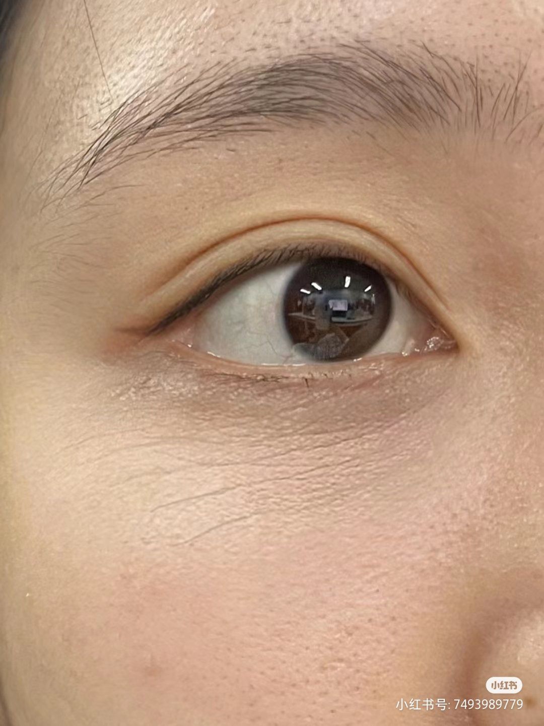 做好眼周抗衰真的很重要#眼尾纹 #鱼尾纹
