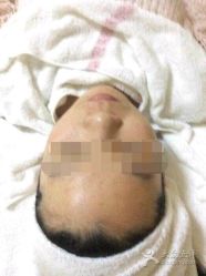 -苗方清颜专业祛痘