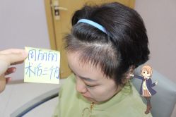 -大麦微针植发丨全国连锁