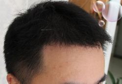 -大麦微针植发丨全国连锁