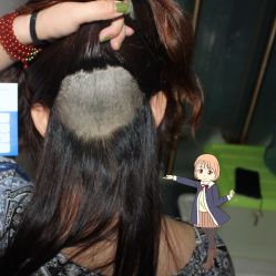 -大麦微针植发丨全国连锁