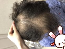 点击看大图 -大麦微针植发丨全国连锁