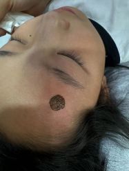 -北京美痣堂古方祛痣斑疣瘊