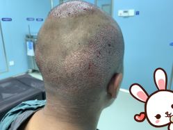 -大麦微针植发丨全国连锁