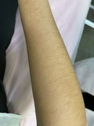 -薇兰专业脱毛连锁机构