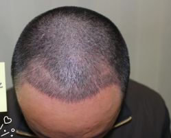 -大麦微针植发丨全国连锁