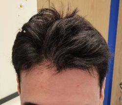 -大麦微针植发丨全国连锁