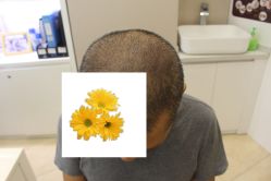 -大麦微针植发丨全国连锁