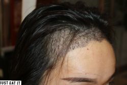 -大麦微针植发丨全国连锁