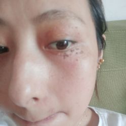 -爱莎扁平疣·汗管瘤·斑痣中心