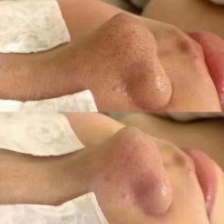 -瑶芳清颜草本祛痘