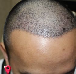 -大麦微针植发丨全国连锁