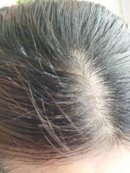 -大麦微针植发丨全国连锁