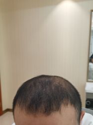 -碧莲盛·不剃发植发