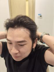 -大麦微针植发全国连锁