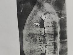 -上海仁爱医院口腔科 · 种植