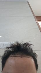 -大麦微针植发全国连锁