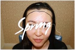 点击看大图 体验后-大麦微针植发全国连锁