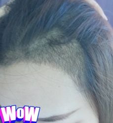 -大麦微针植发丨全国连锁