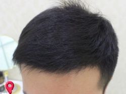 -大麦微针植发丨全国连锁