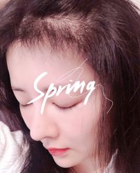 体验后-大麦微针植发全国连锁