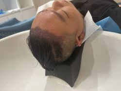 -大麦微针植发全国连锁