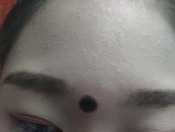 -北京美痣堂古方祛痣斑疣瘊
