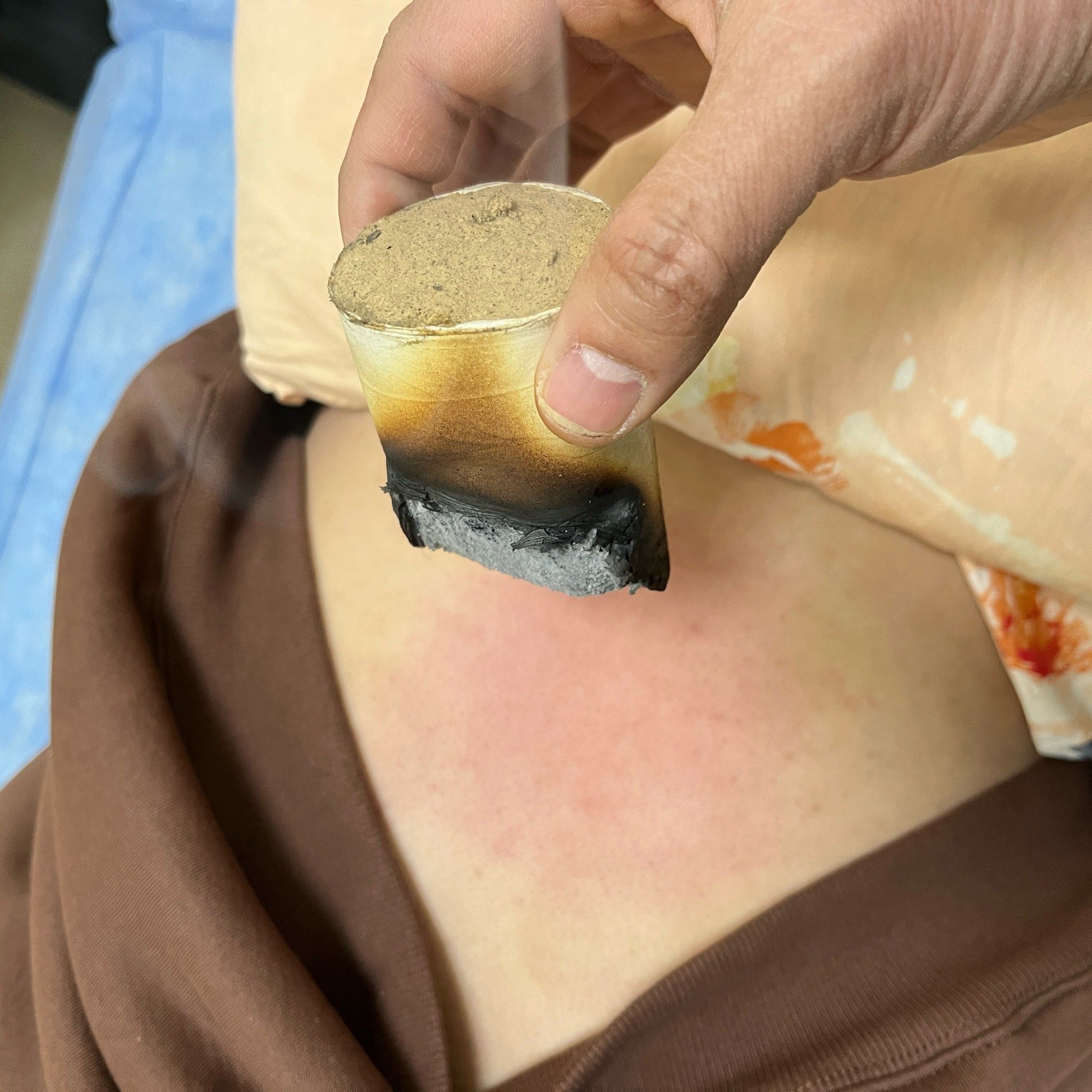 中医艾灸治身体