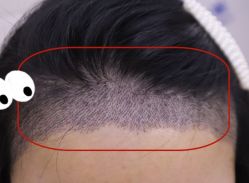 -大麦微针植发全国连锁