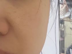 体验前-比华利美容医院