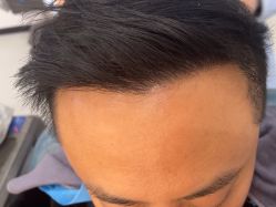 -大麦微针植发全国连锁