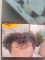 -碧莲盛·不剃发植发