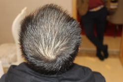 -大麦微针植发丨全国连锁