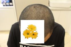 -大麦微针植发丨全国连锁