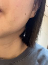 点击看大图 体验后-广州美莱医疗美容医院