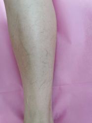 -薇兰专业脱毛连锁机构