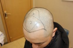 -大麦微针植发丨全国连锁