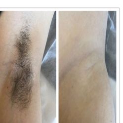-小梨专业脱毛连锁机构