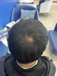 -大麦微针植发全国连锁