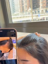 -碧莲盛·不剃发植发