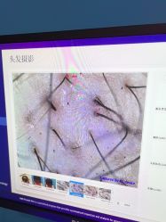-大麦微针植发全国连锁