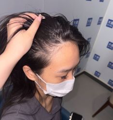 -大麦微针植发全国连锁