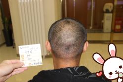 点击看大图 -大麦微针植发丨全国连锁