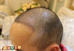 -大麦微针植发丨全国连锁