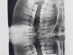 -上海仁爱医院口腔科 · 种植