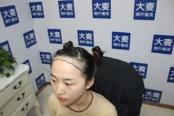 -大麦微针植发丨全国连锁
