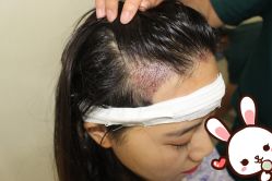 -大麦微针植发丨全国连锁