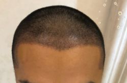 -大麦微针植发丨全国连锁