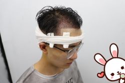 点击看大图 -大麦微针植发丨全国连锁