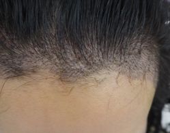 -大麦微针植发全国连锁